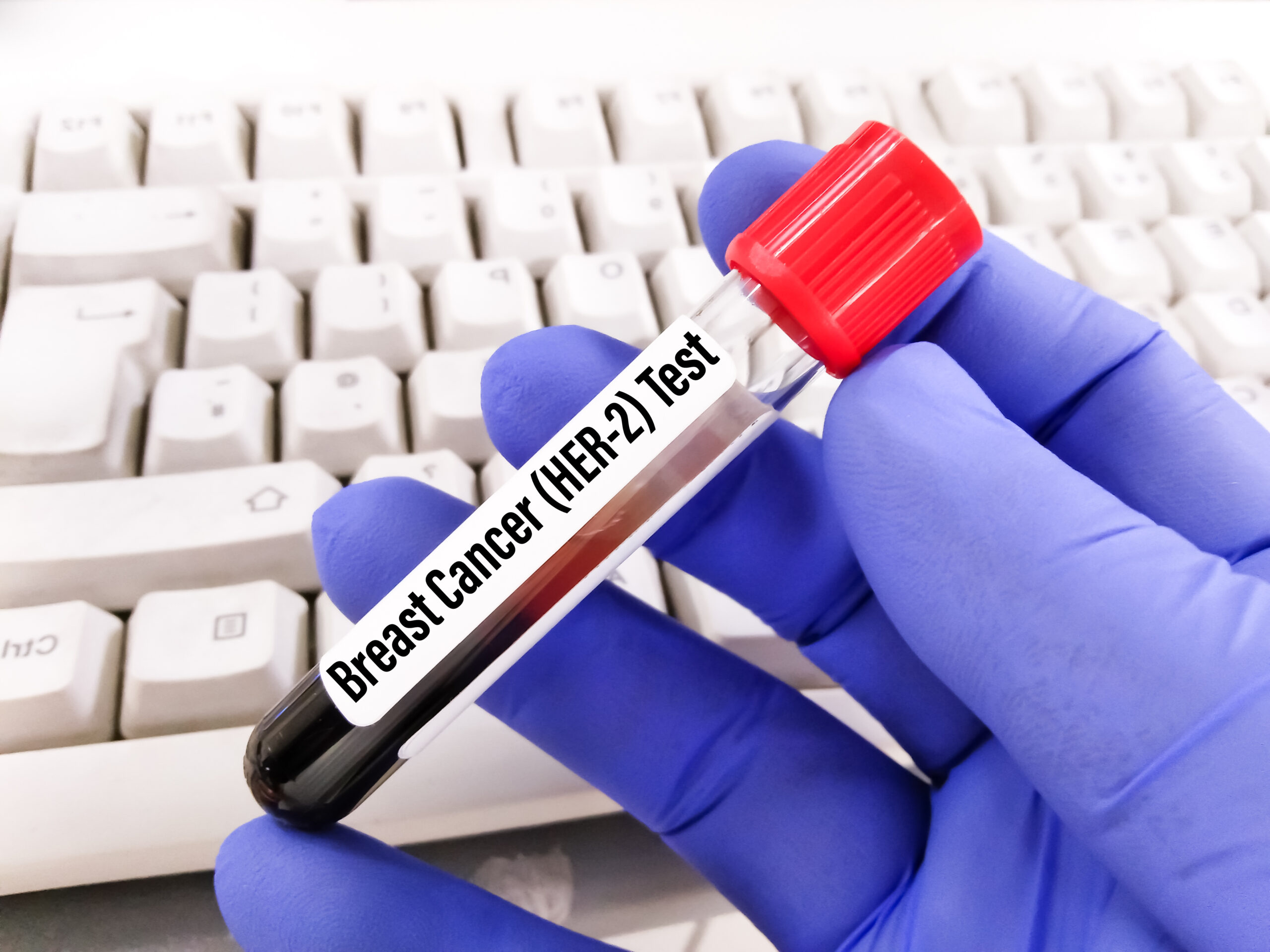 blood-sample-for-her-2-breast-cancer-testing-human-epidermal-growth-factor-receptor-2-her2-erbb2